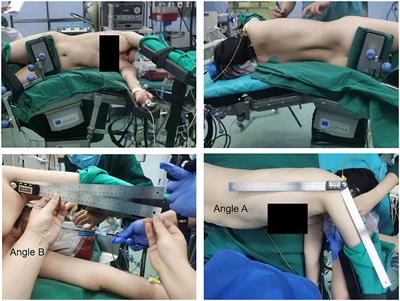 Effect of Upper Arm Position Changes on the Occurrence of Ipsilateral Shoulder Pain After Single-Operator Port Thoracoscopy